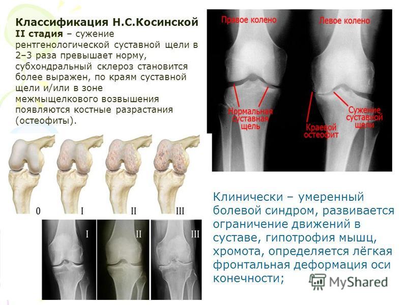 Диагноз доа суставов. Деформирующий артроз коленного сустава схема. Деформирующий артроз коленного сустава стадии. Стадии доа коленных суставов рентген.