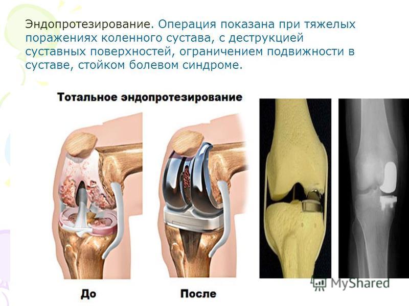 Артроз коленного сустава мениск. Деформирующий гонартроз коленного сустава. Деформирующий артроз 1-2 степени. Деформирующий артрит коленного сустава. Деформирующий остеоартроз 1 степени коленного.
