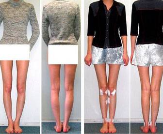Какую одежду носить с кривыми ногами