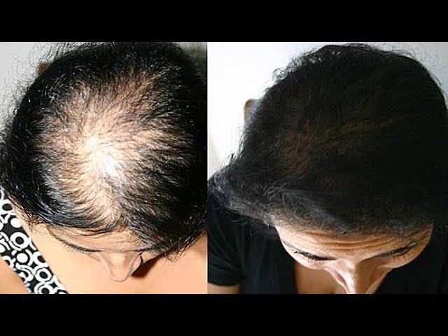 Почему выпадают волосы на голове у женщин в менопаузе