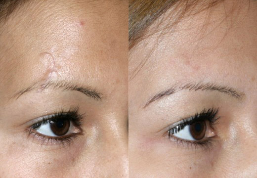 до и после лечения шрамов