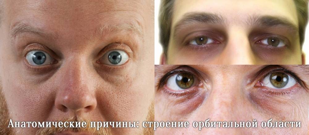 Лечение мешков под глазами у мужчин. Синяки под глазами причины. Генетические синяки под глазами. Наследственные мешки под глазами. Кровоподтек под глазом.