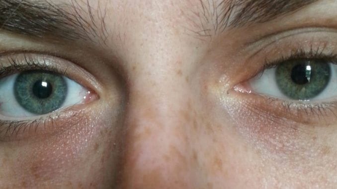 Heterochromia grey eye and brownish blue eye