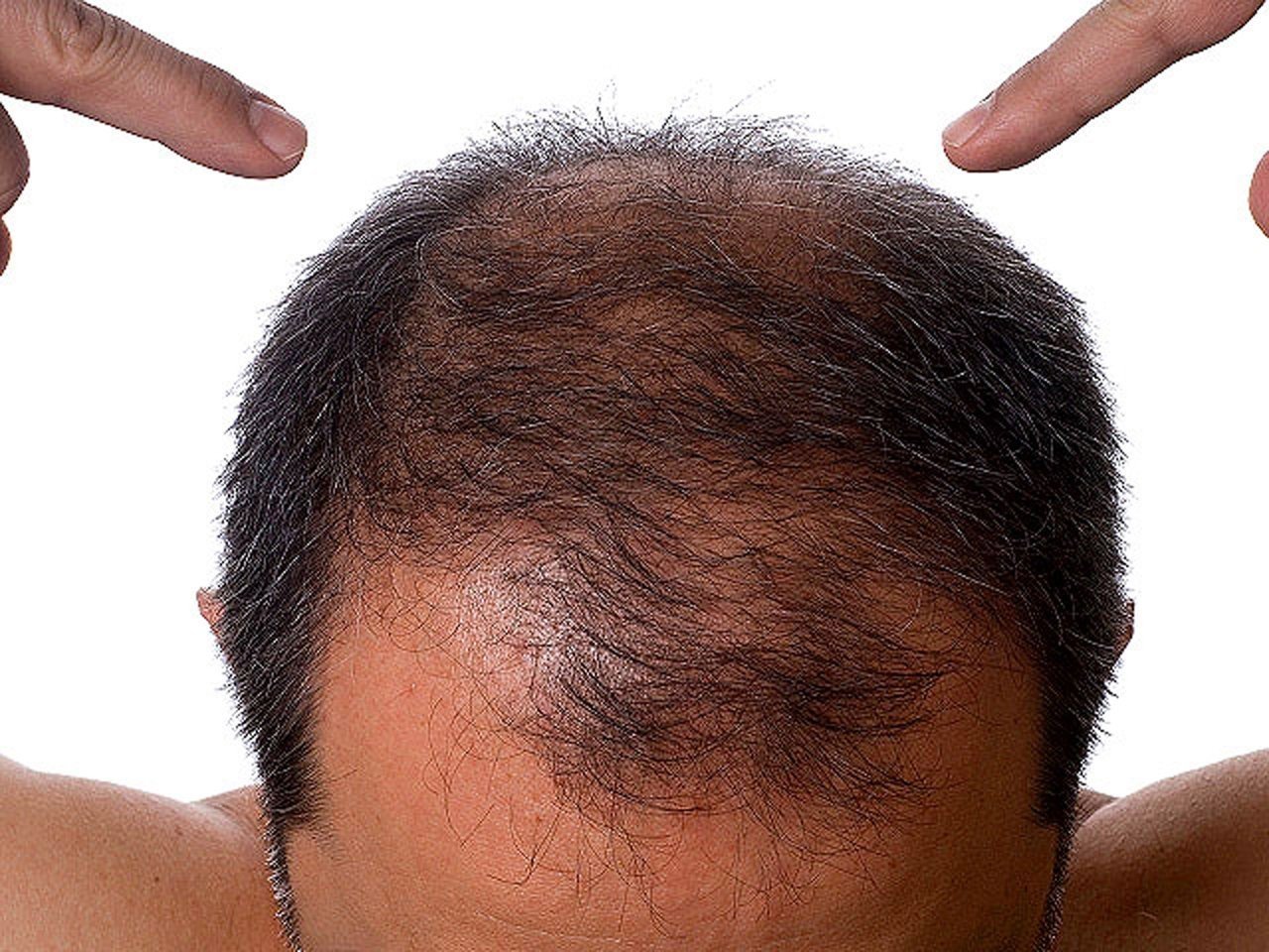 Причины выпадения волос у подростка. Неопластическая алопеция.