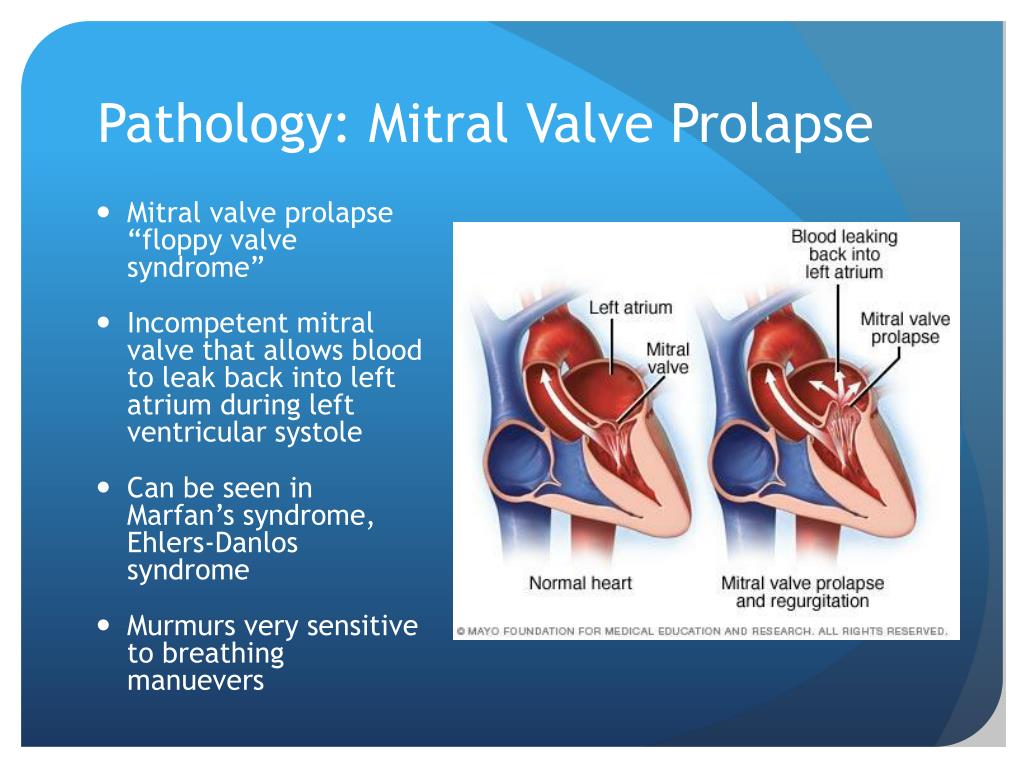Пролапс митрального клапана презентация