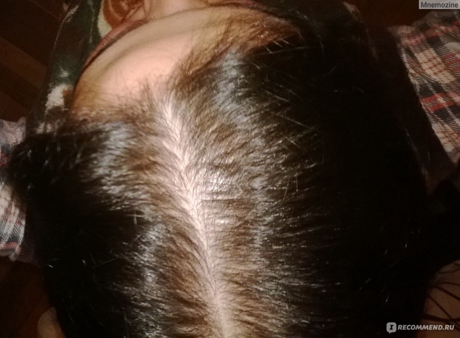Выпадают ли волосы от элоксатин