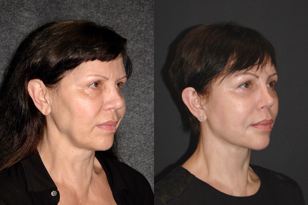 Фейслифтинг лица фото до и после