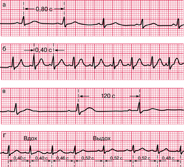 Дыхательная аритмия. Номотопные аритмии ЭКГ. Номотопный водитель ритма синусовая брадикардия. Синусовая и дыхательная аритмия сравнение. Фатальные аритмии.