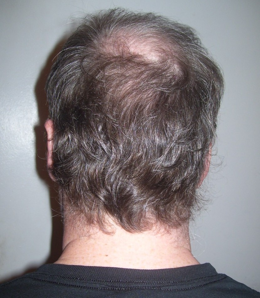 Повреждение волос выпадение лечение
