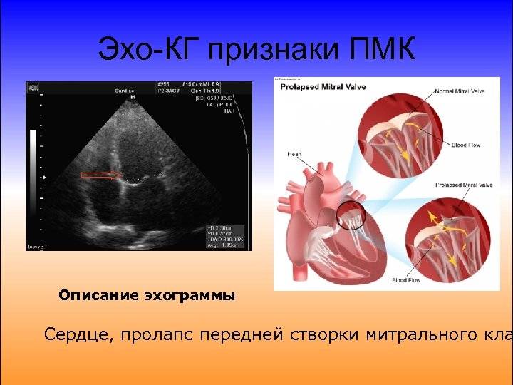 Пролапс митрального клапана картинка