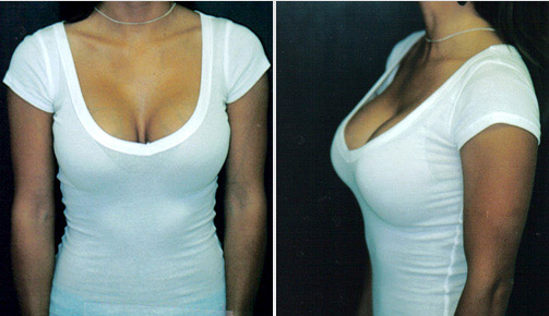 Круглые импланты до и после 3 размер фото