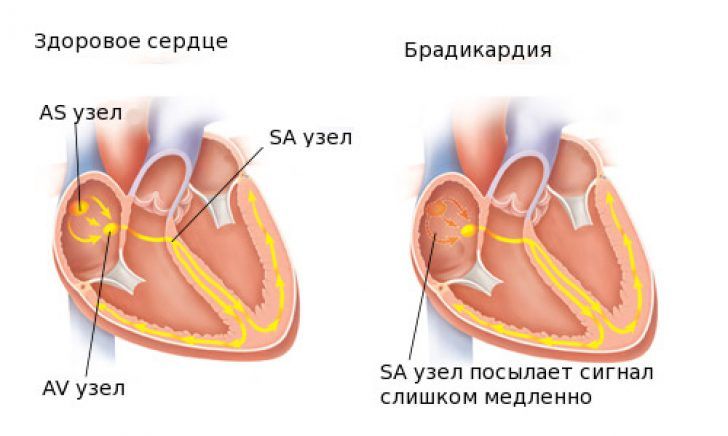 брадикардия сердца